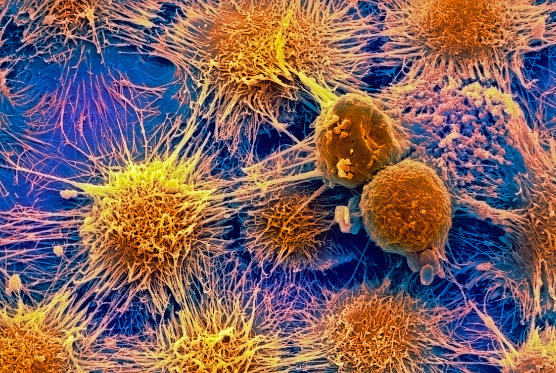 Kidney cancer cells,SEM
