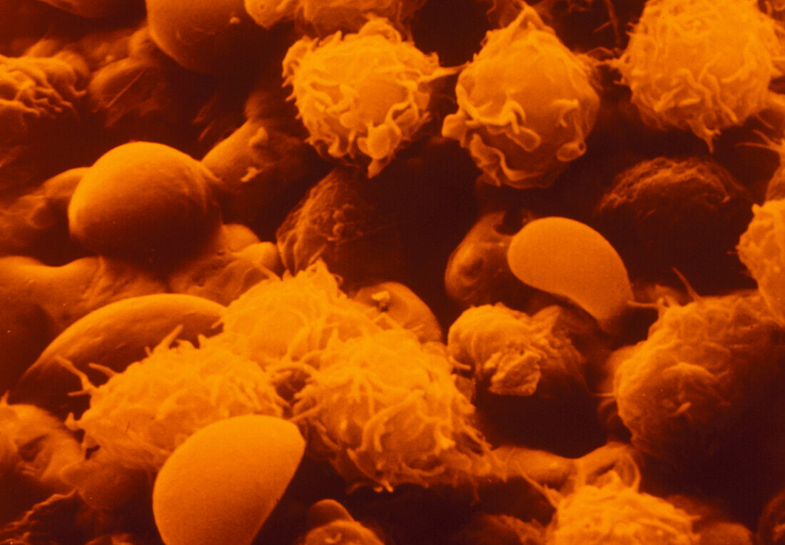False-col SEM white blood cells from CML patient