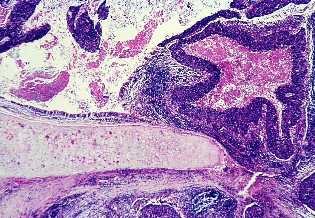 Squamous cell cancer of lung