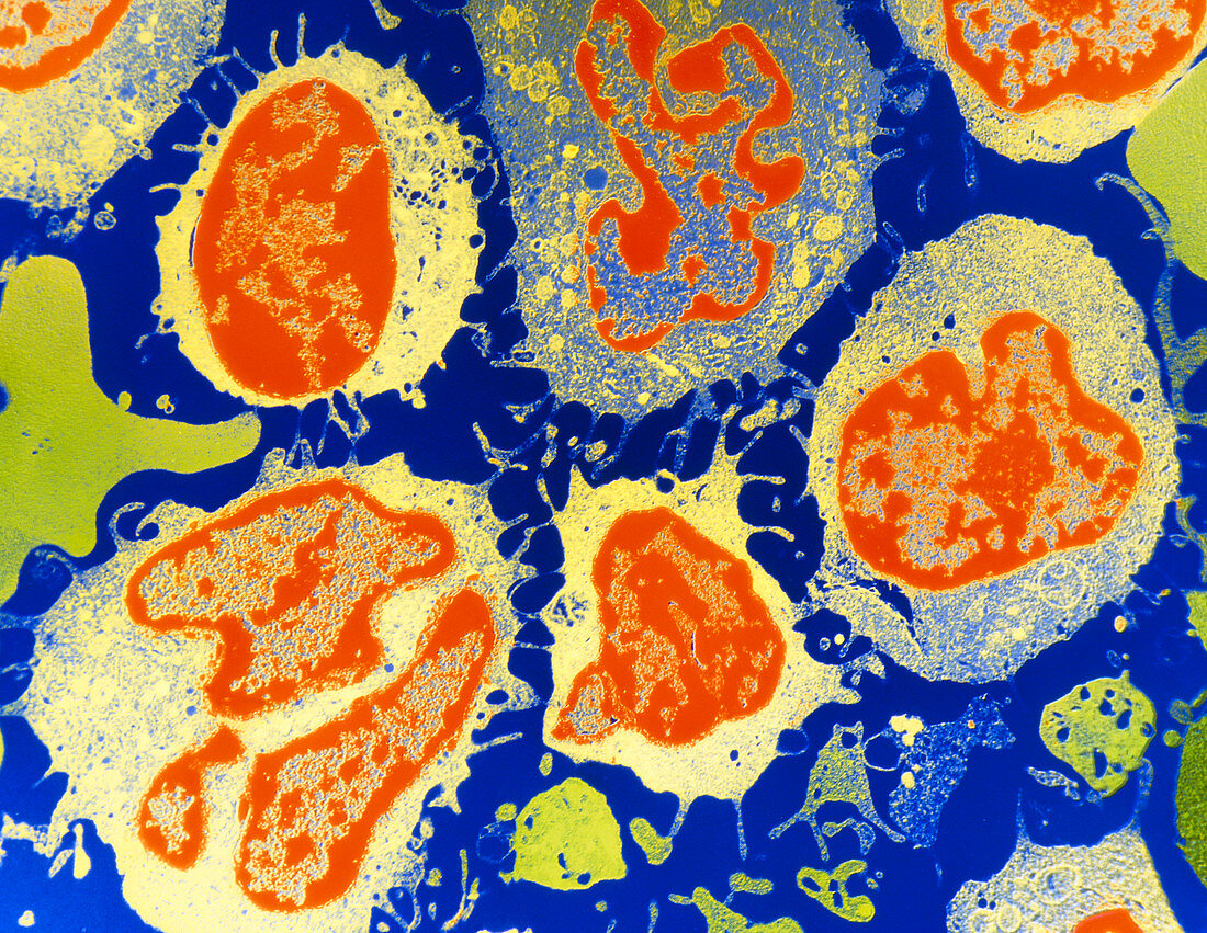 Coloured TEM of hairy-cell leukaemia