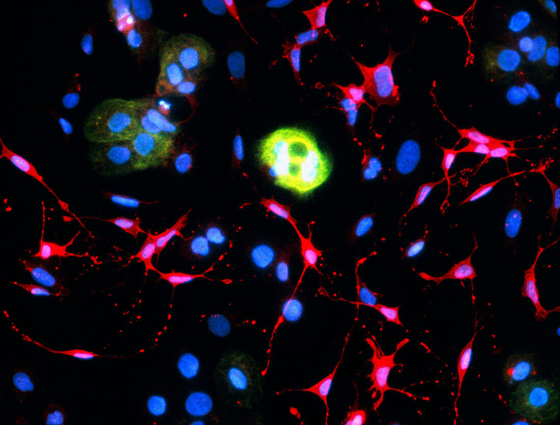 Immunofluorescent LM of neuroblastoma cancer cells