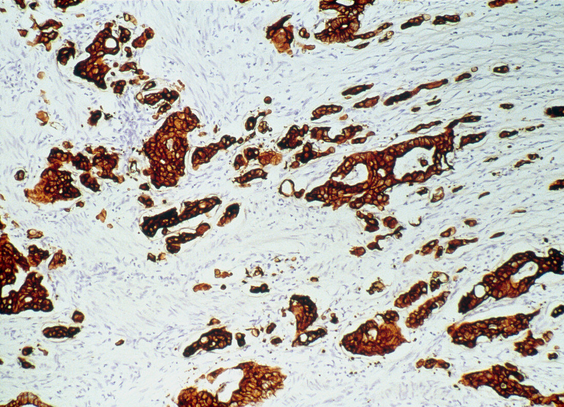 Light micrograph of colon cancer cells