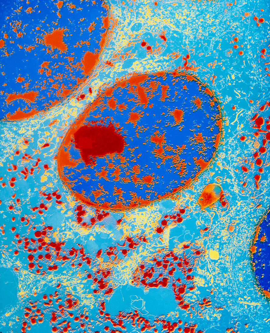 Coloured TEM of carcinoid (neuroendocrine) tumour