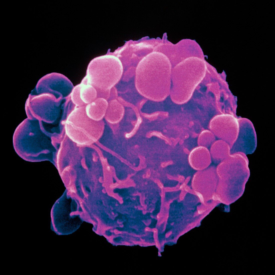 Coloured SEM of induced apoptosis in cancer cell