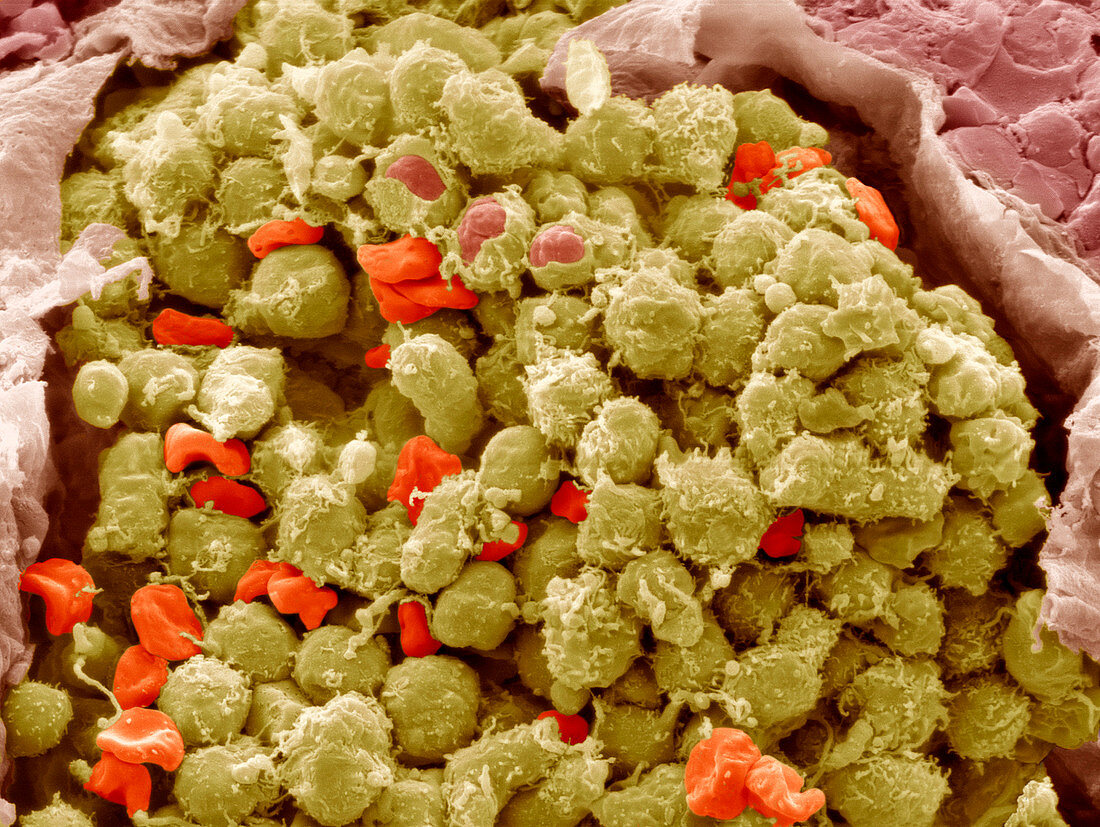 Lymphoma cancer cells,SEM