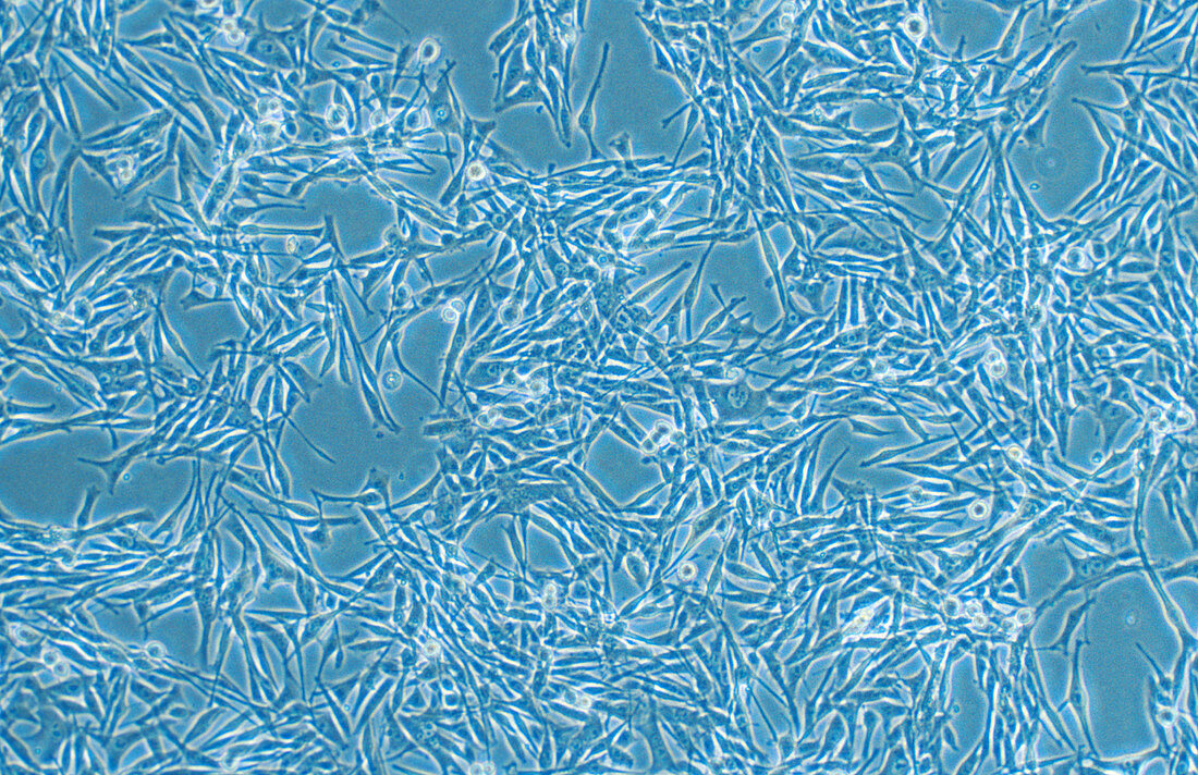 Skin cancer cells,light micrograph