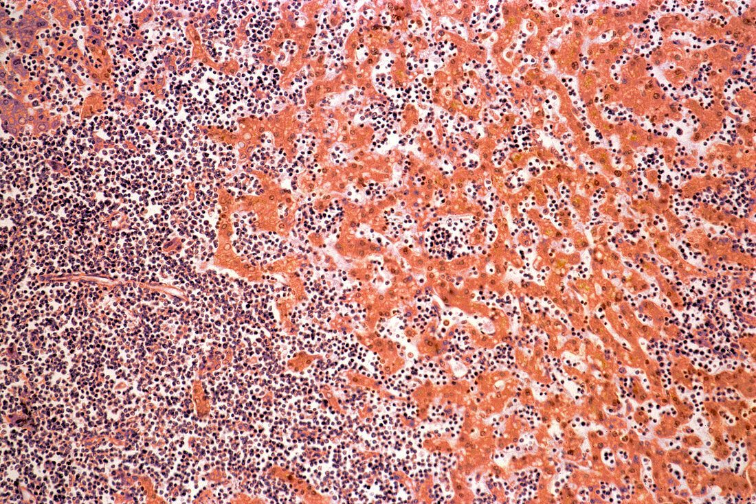 Leukaemia blood cells,light micrograph