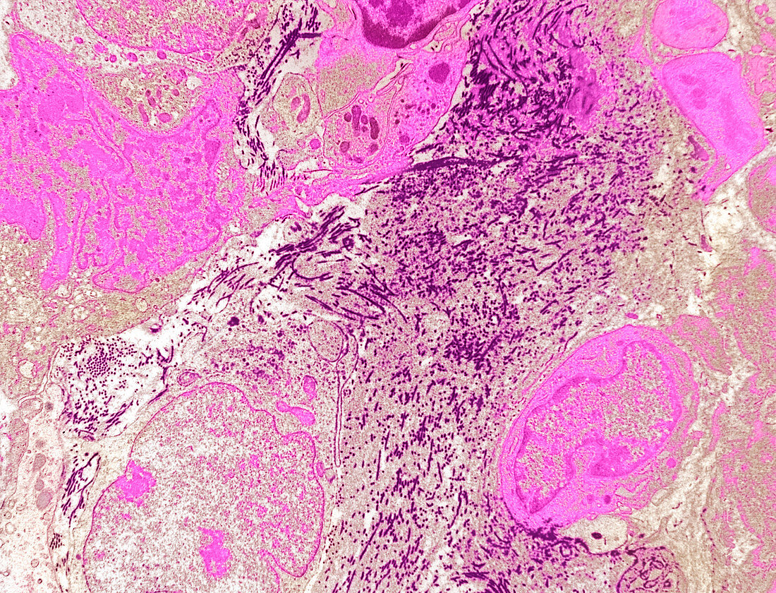 Soft tissue sarcoma,TEM