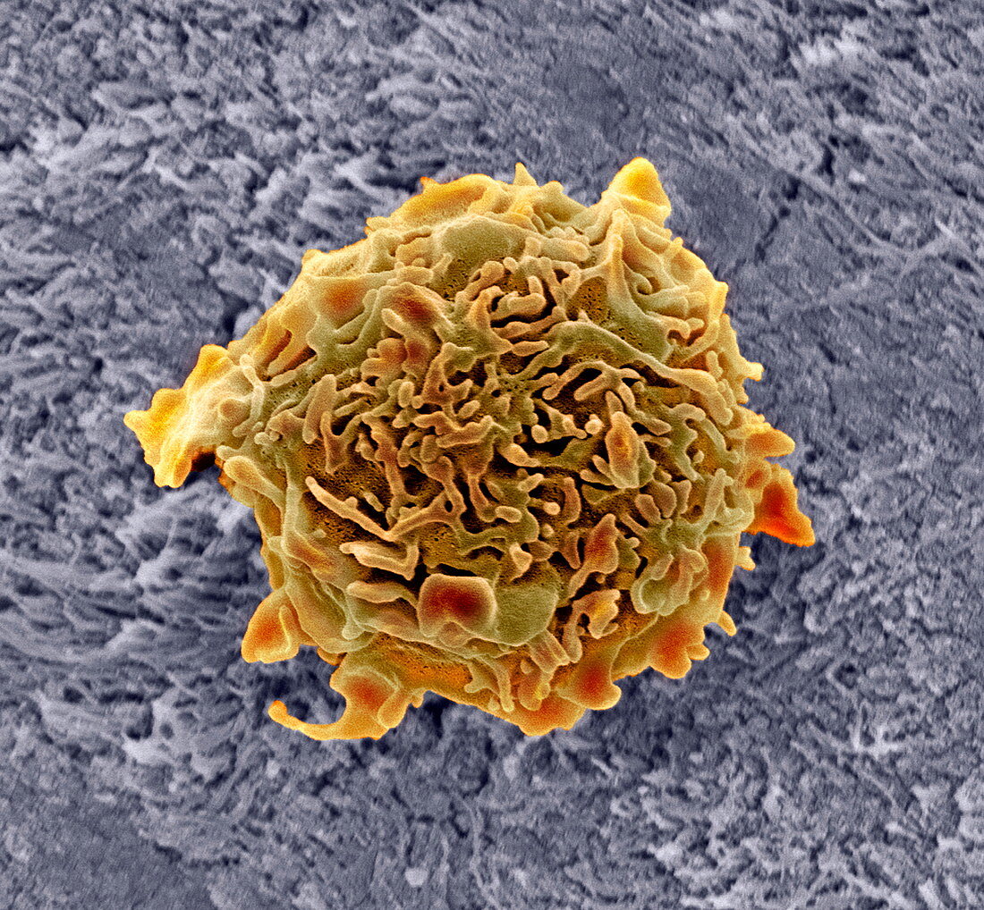 Bone cancer cell,SEM