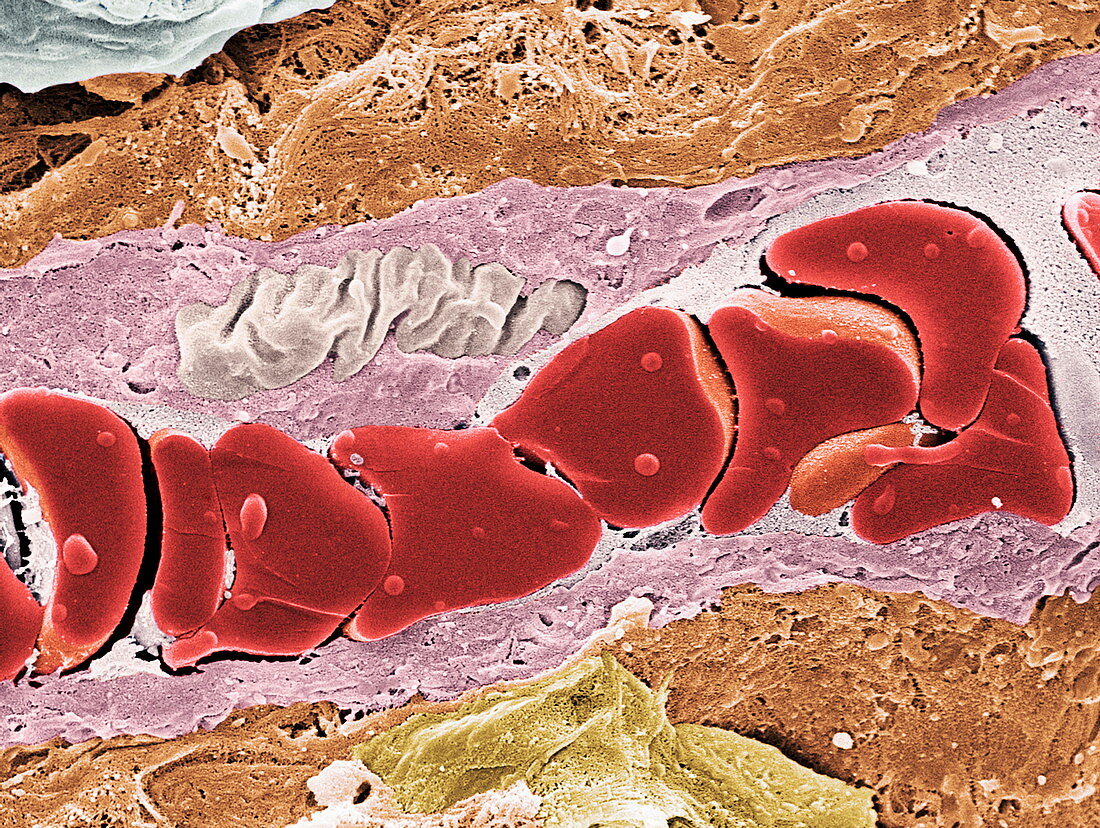 Tumour blood vessel,SEM