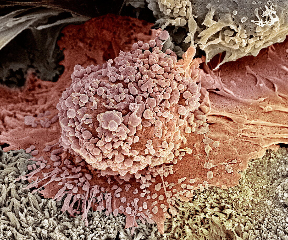 Bone cancer cell,SEM