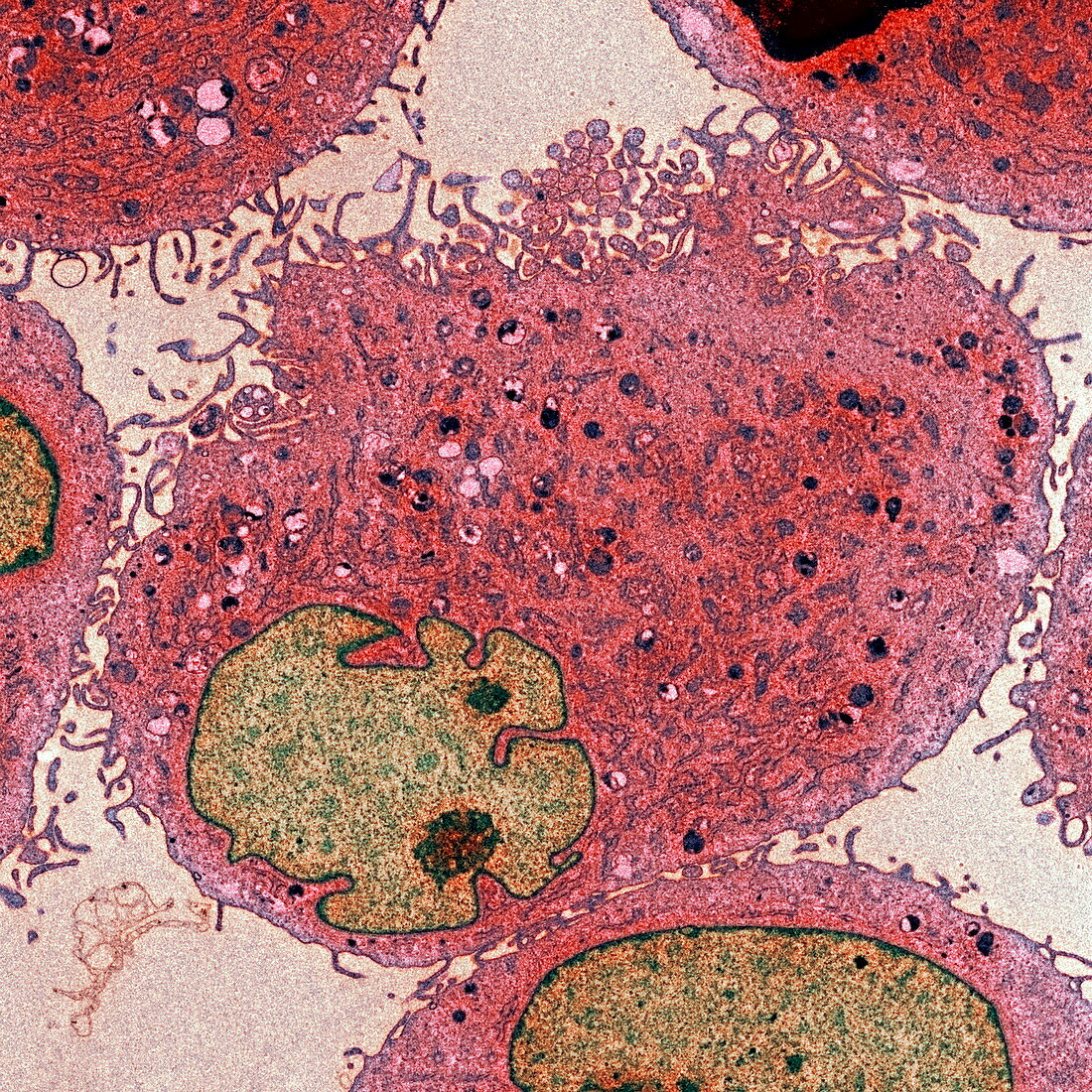 Leukaemia cells,TEM