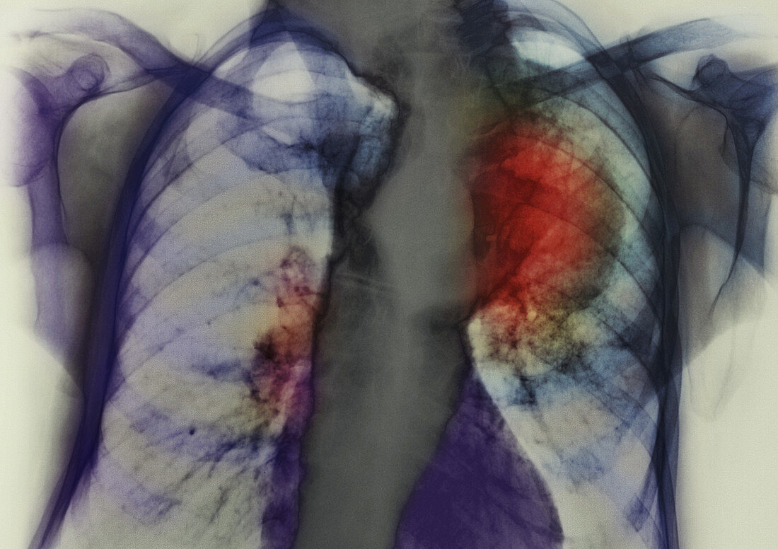 Lung cancer X-ray