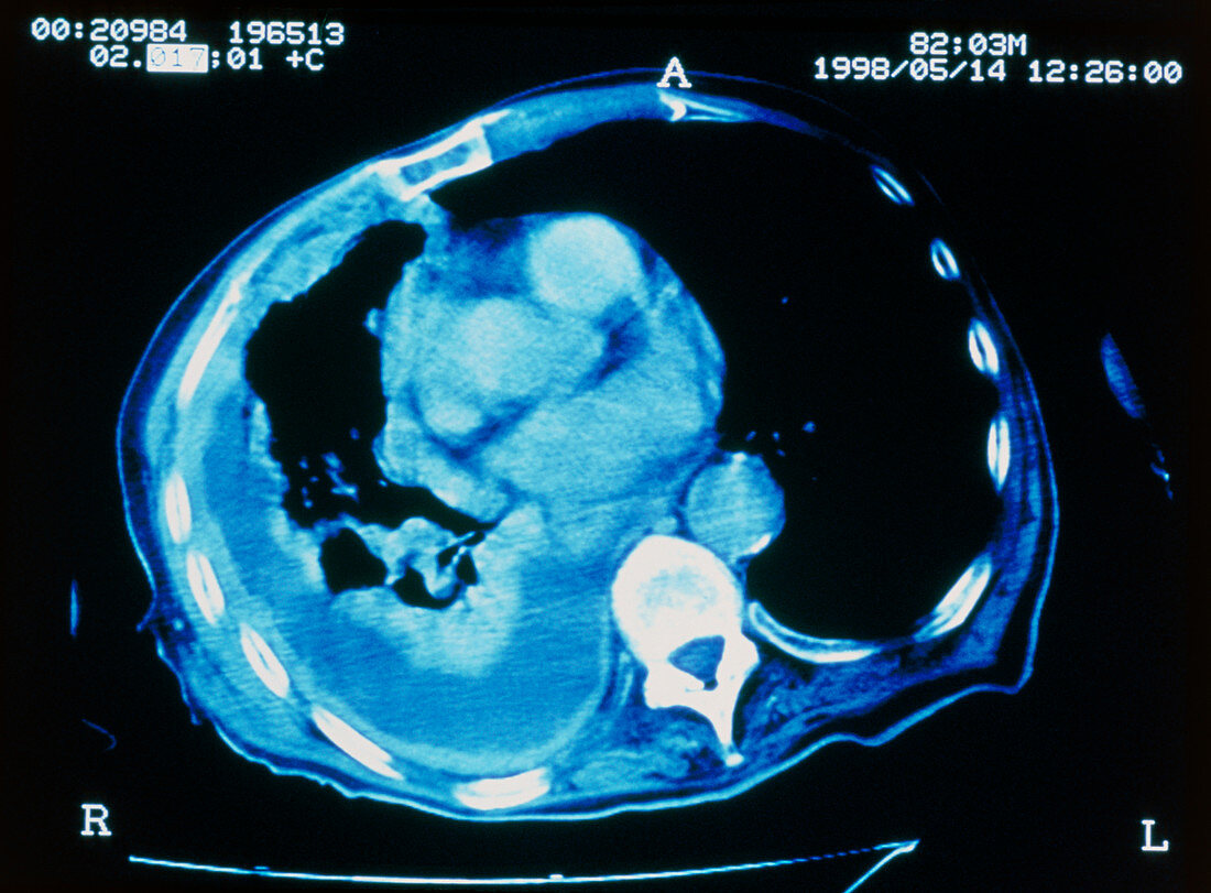 Mesothelioma lung cancer