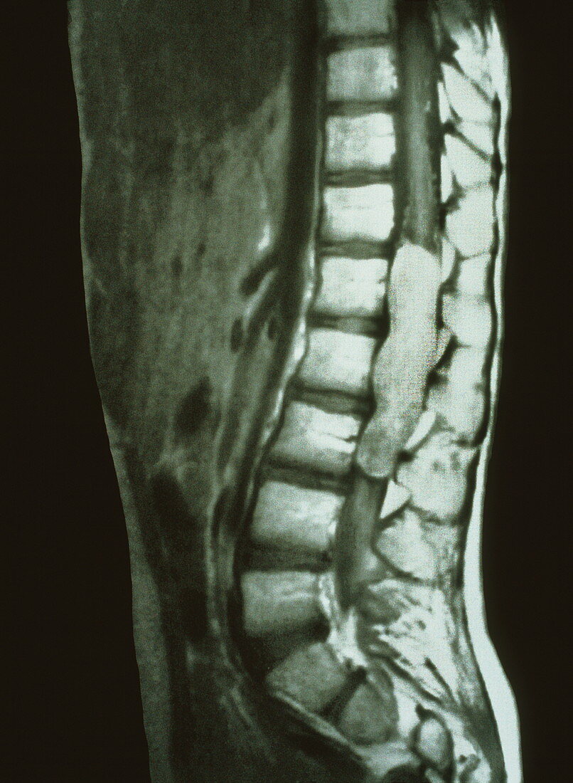 Spinal cord cancer MRI
