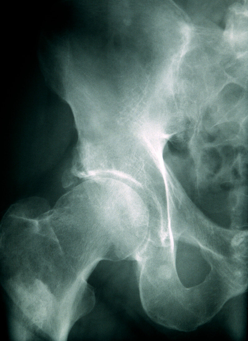 Secondary bone cancer,X-ray