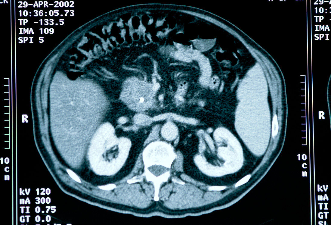 Pancreas cancer,CT scan
