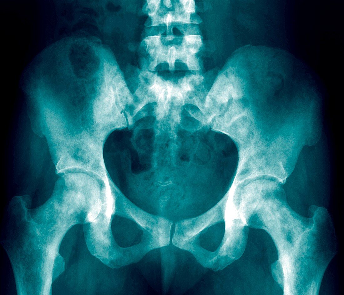 Bone cancers,pelvic X-ray