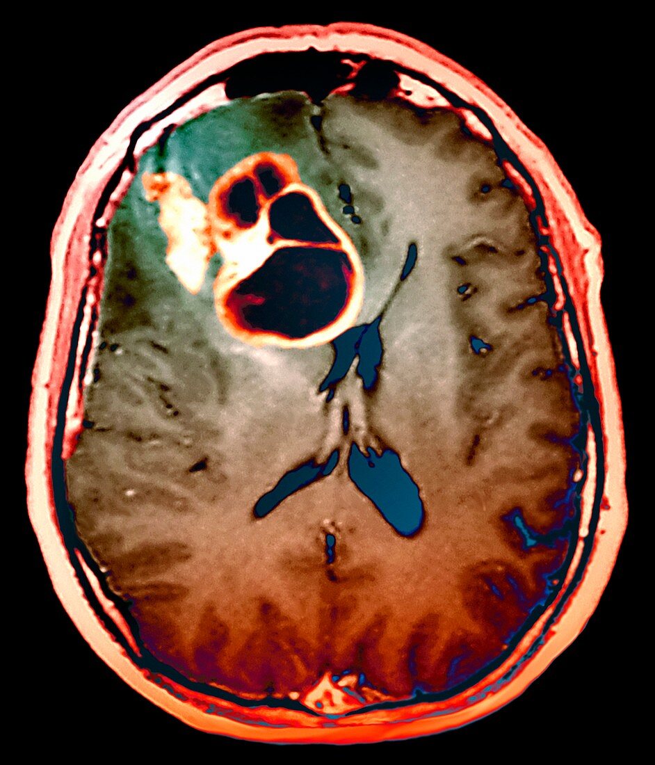 Brain cancer,MRI scan