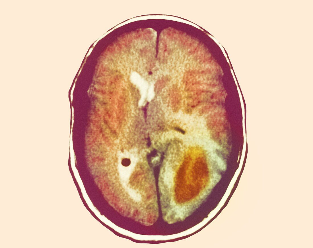 Glioma brain cancer,CT scan