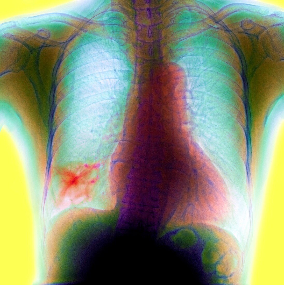 Lung cancer,X-ray