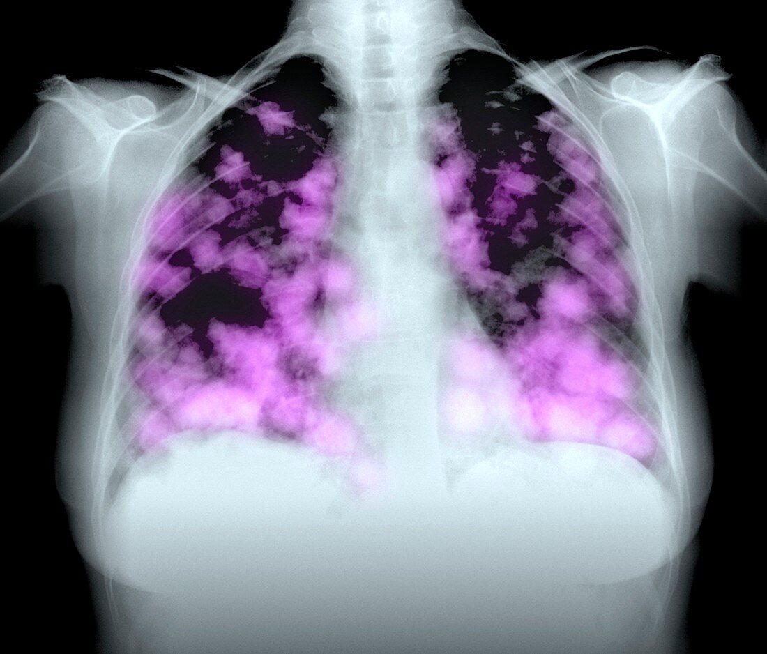 Secondary lung cancers,X-ray