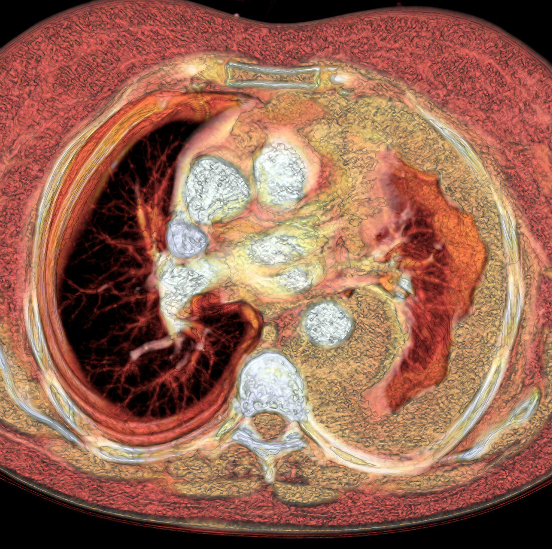 Lung cancer,CT scan