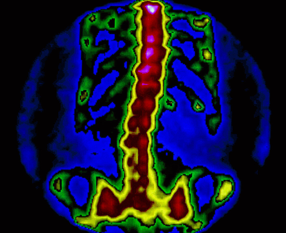 Bone scan of human spine and ribs