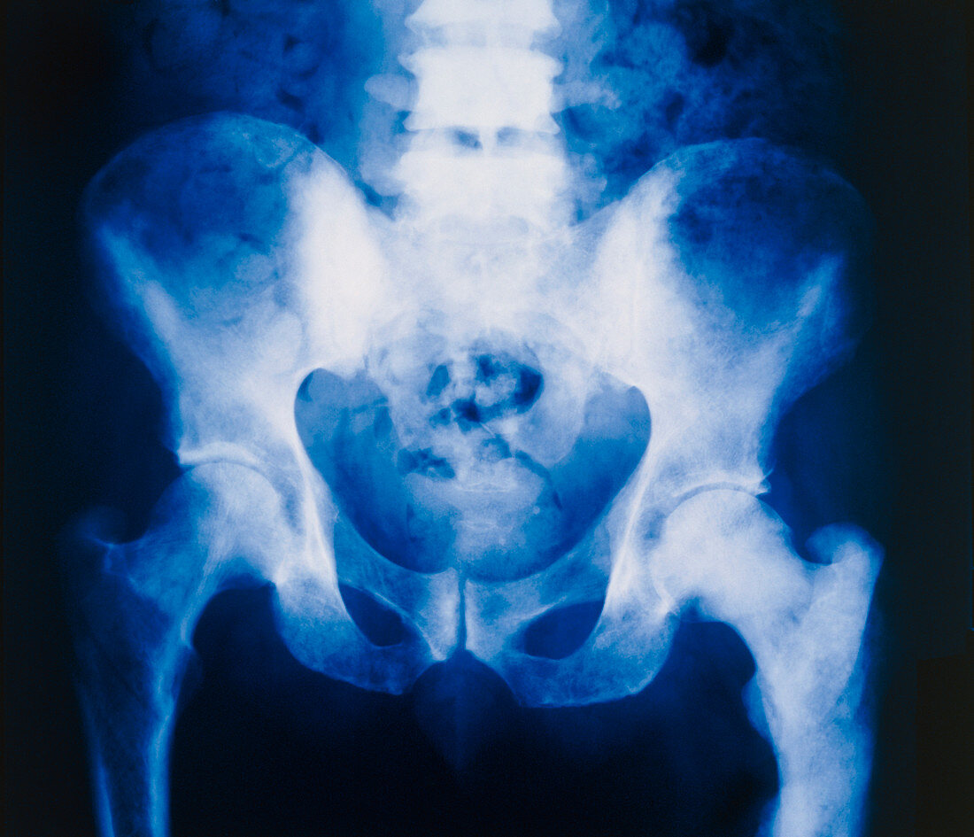 Prostate cancer: X-ray of secondary bone tumours