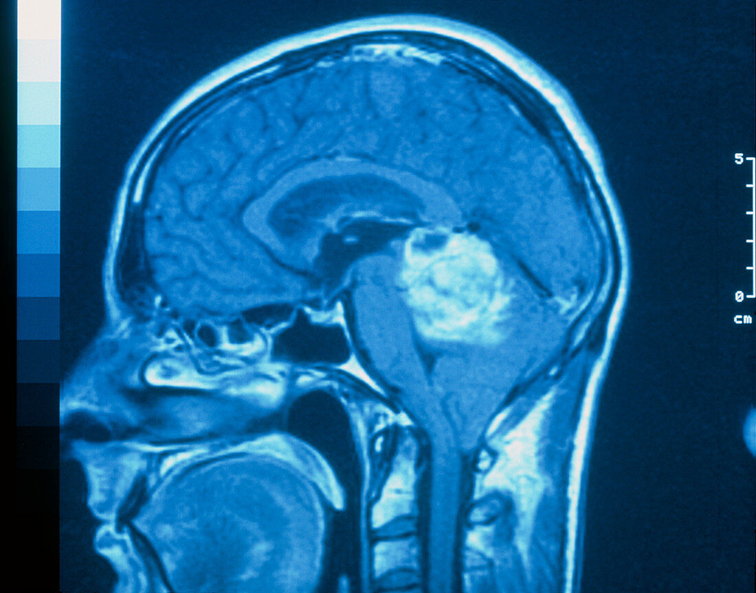 MRI scan of brain tumour - cerebellar glioma