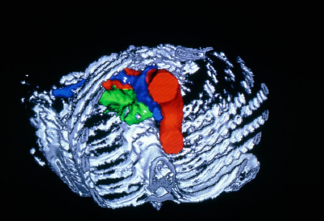 False-colour 3-D CT image of pancreatic tumour
