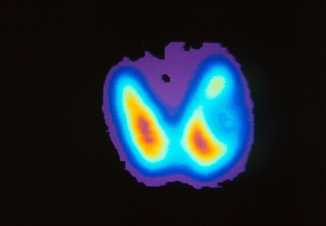 Coloured Gamma scan of thyroid cancer