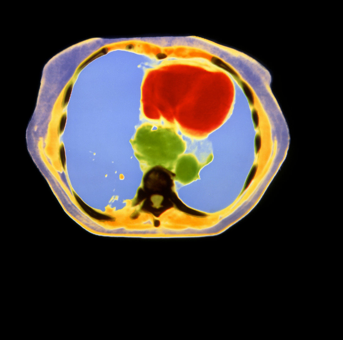 Coloured CT scan showing cancer of the oesophagus