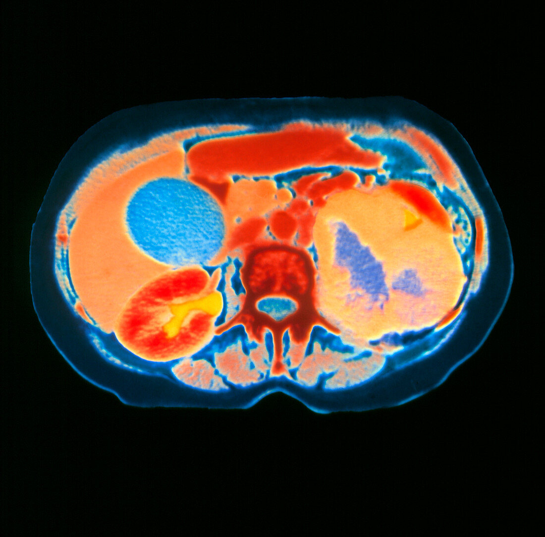 CT scan showing kidney cancer