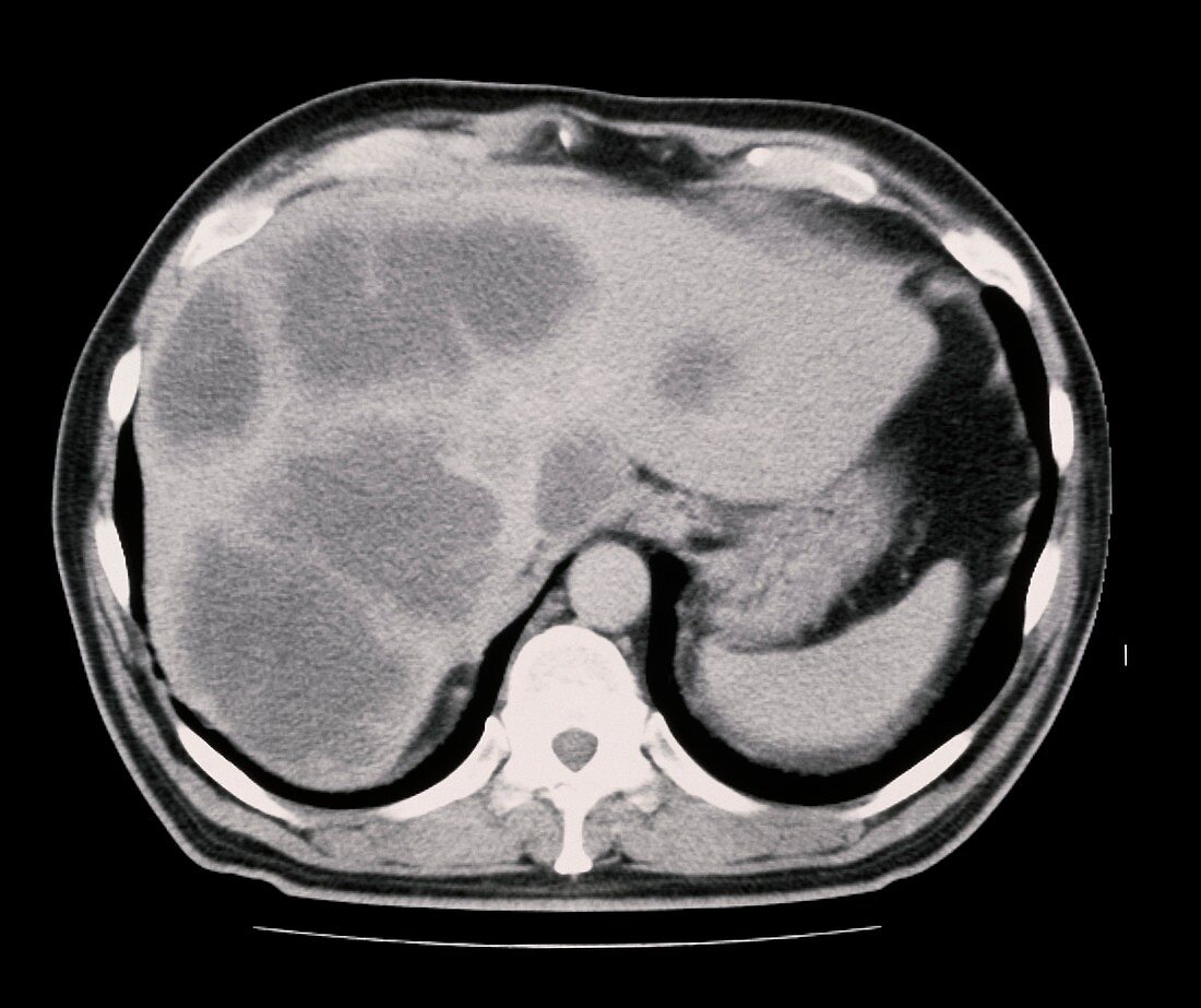 CT scan showing cancer of the liver