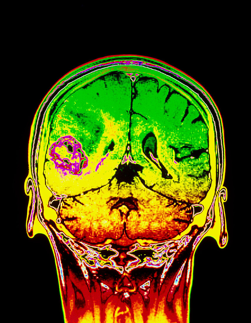 Coloured MRI scan of a metastatic brain tumour