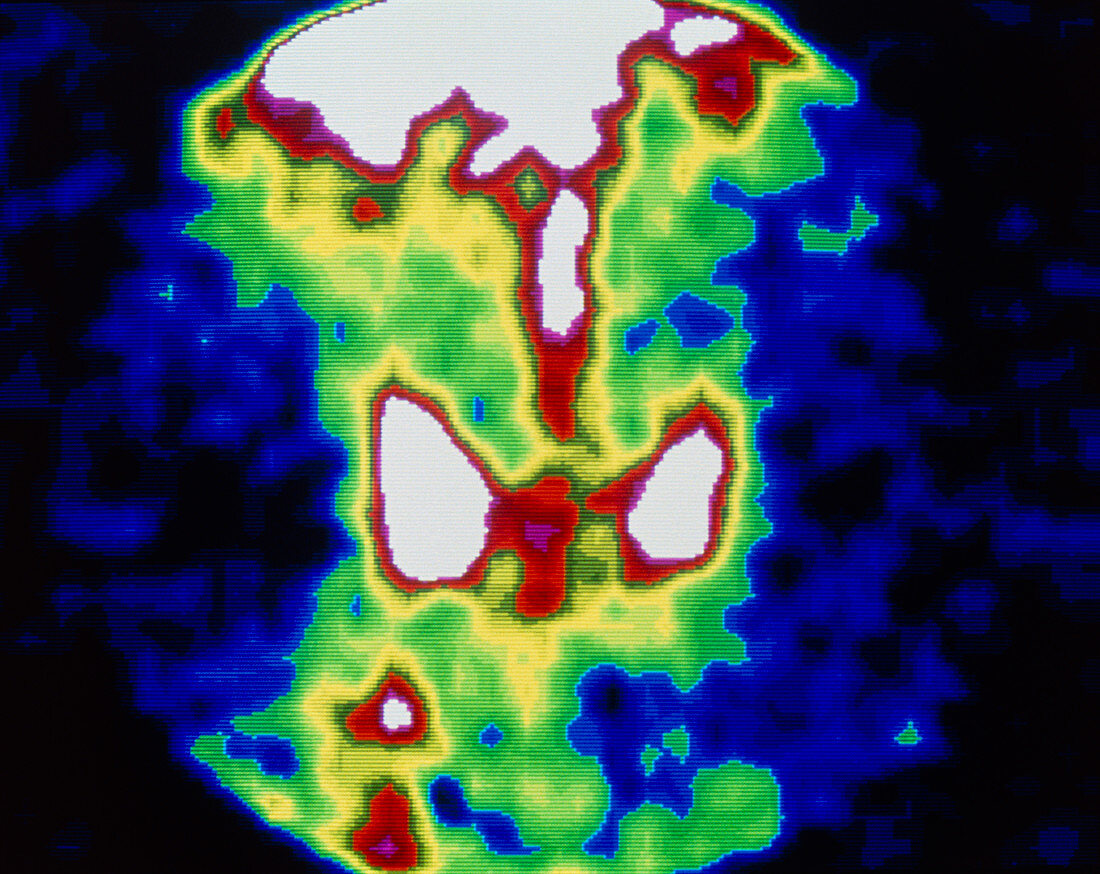 Coloured gamma scan of metastatic cancer in femur