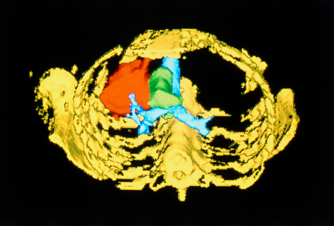 3-D computed tomography scan of lung cancer