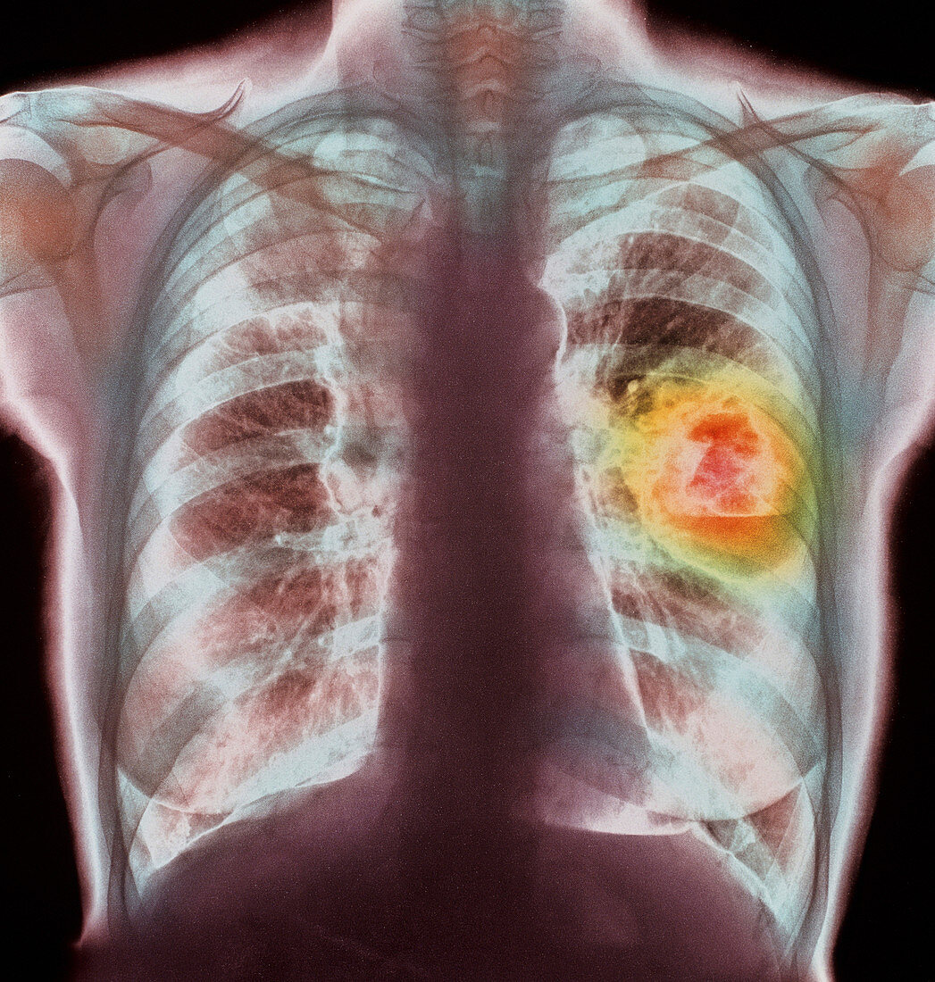 Coloured X-ray showing lung cancer