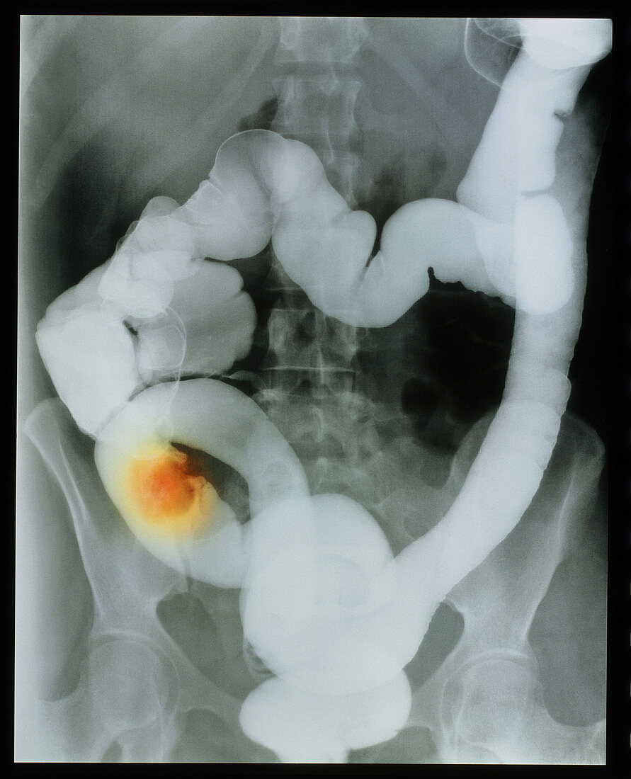 Coloured X-ray of cancer of the colon