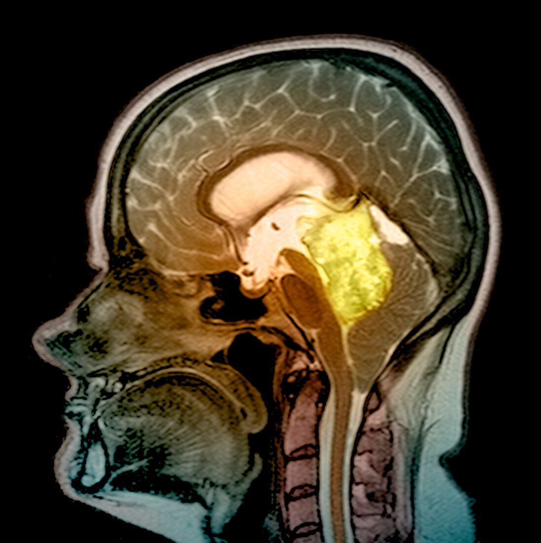 Pineal gland tumour,MRI scan
