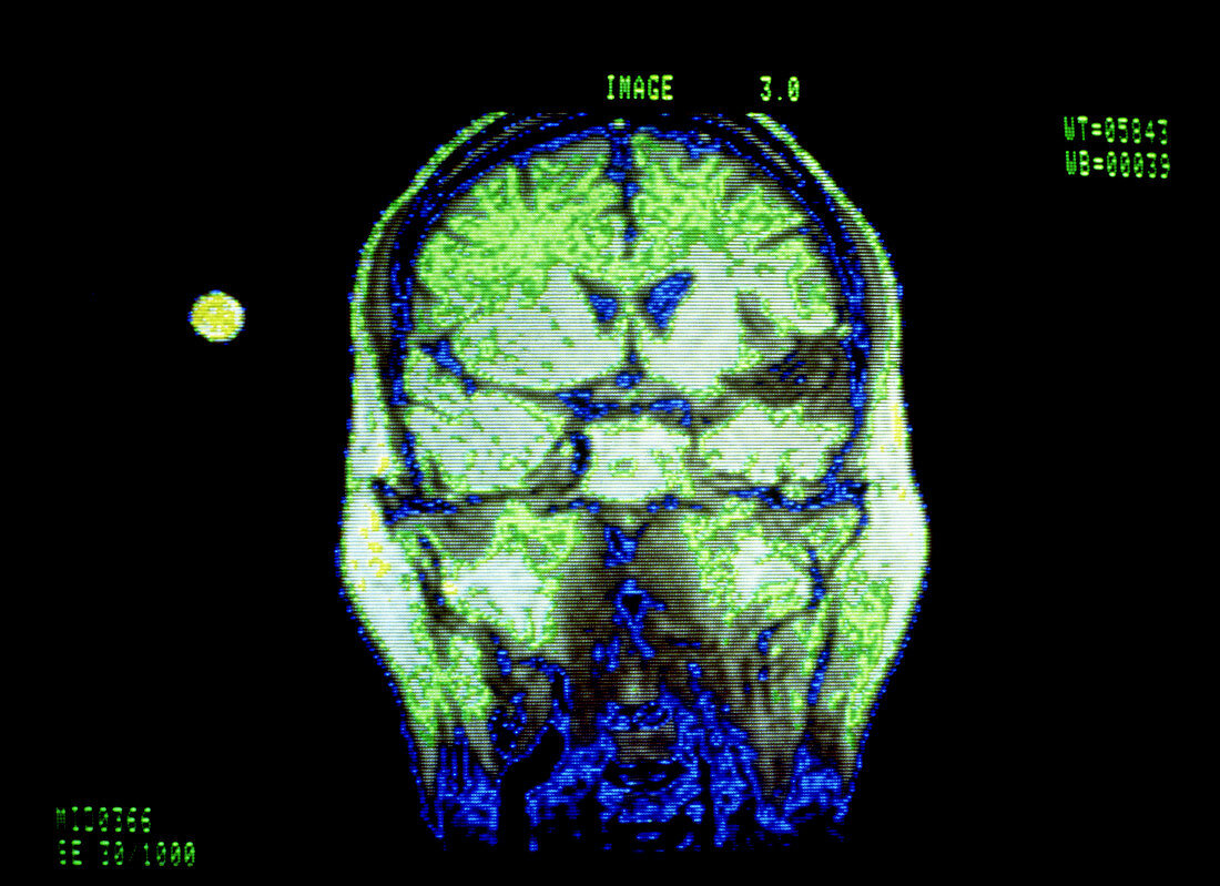 False-col NMR image of coronal section of brain