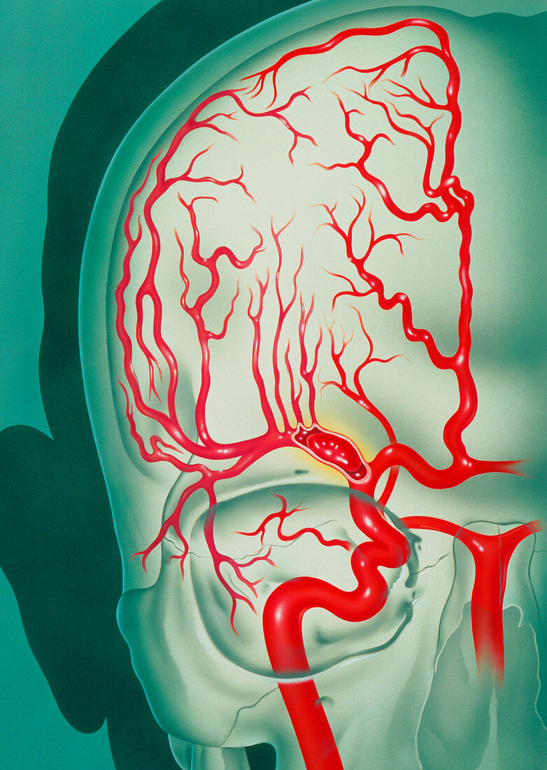Cerebral vascular accident (CVA): embolism artwork