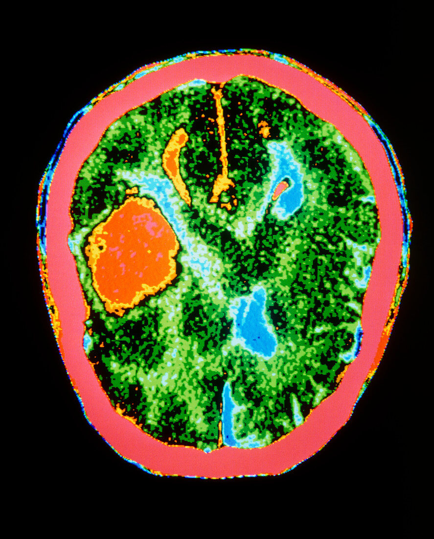 False-colour CT scan of brain ischaemia