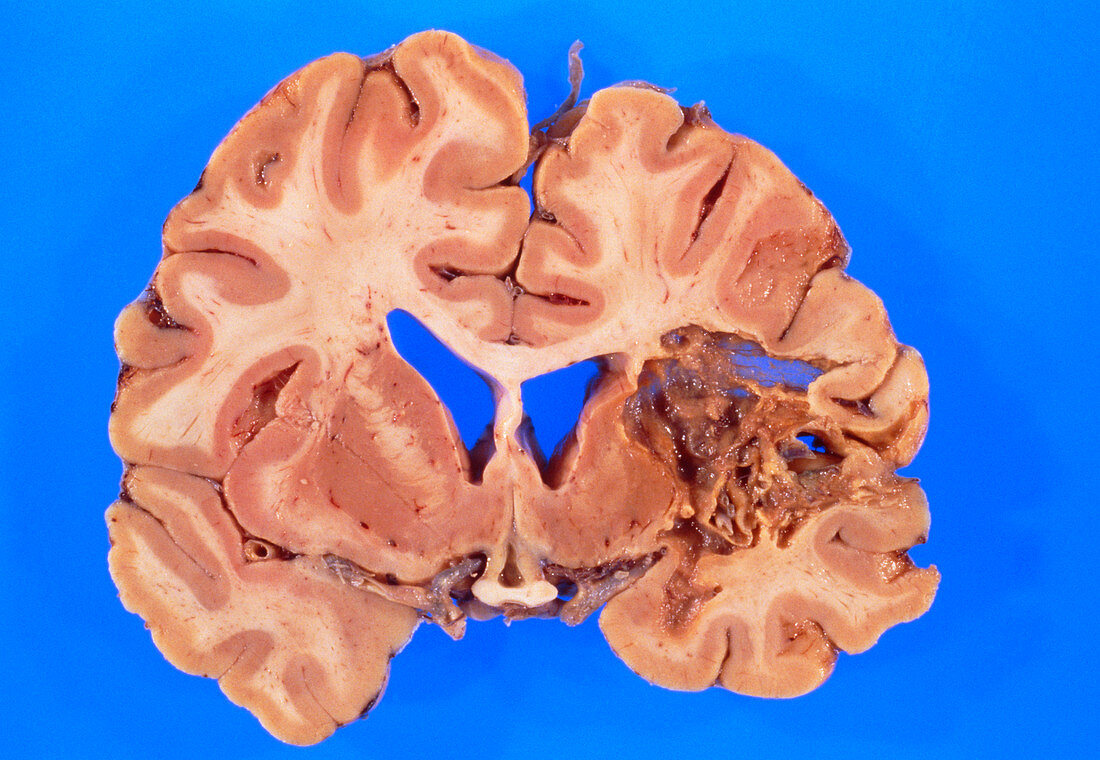 Coronal section of brain with cerebral infarction