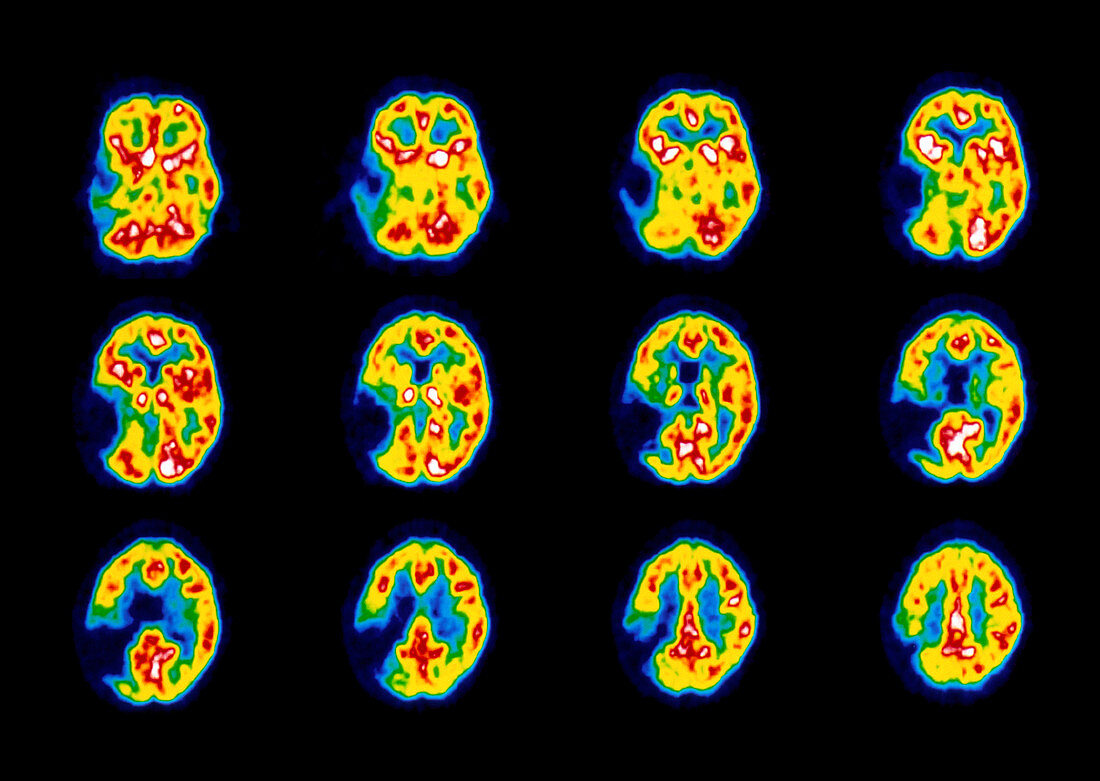 Colour PET scans of the brain of a stroke patient