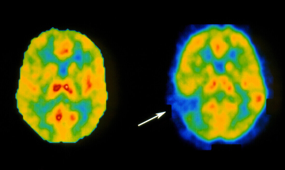 Colour PET brain scans of stroke vs normal patient