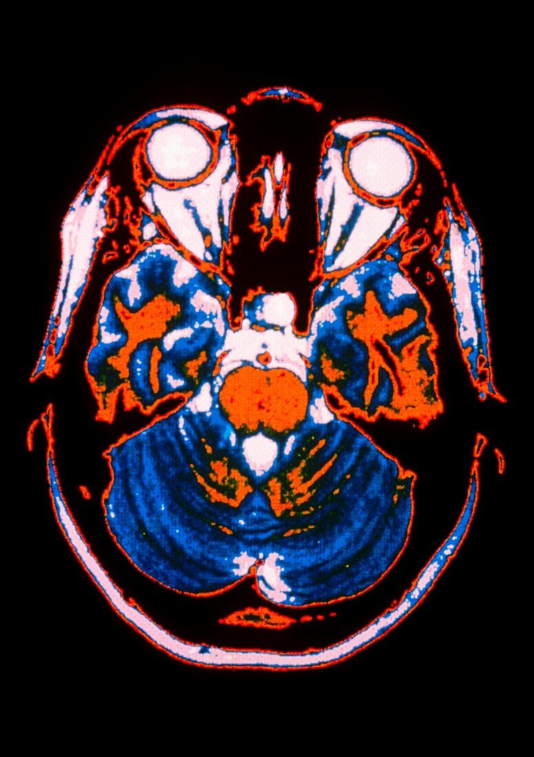 Coloured CT scan of brain following stroke