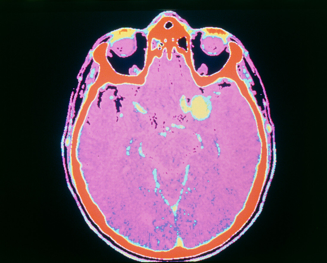 Computed tomography scan of a cerebral aneurysm