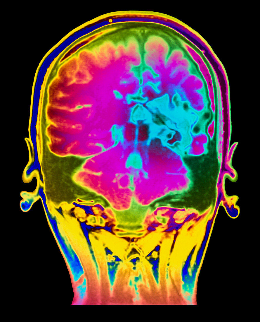 Colour MRI brain scan of arteriovenous malfunction